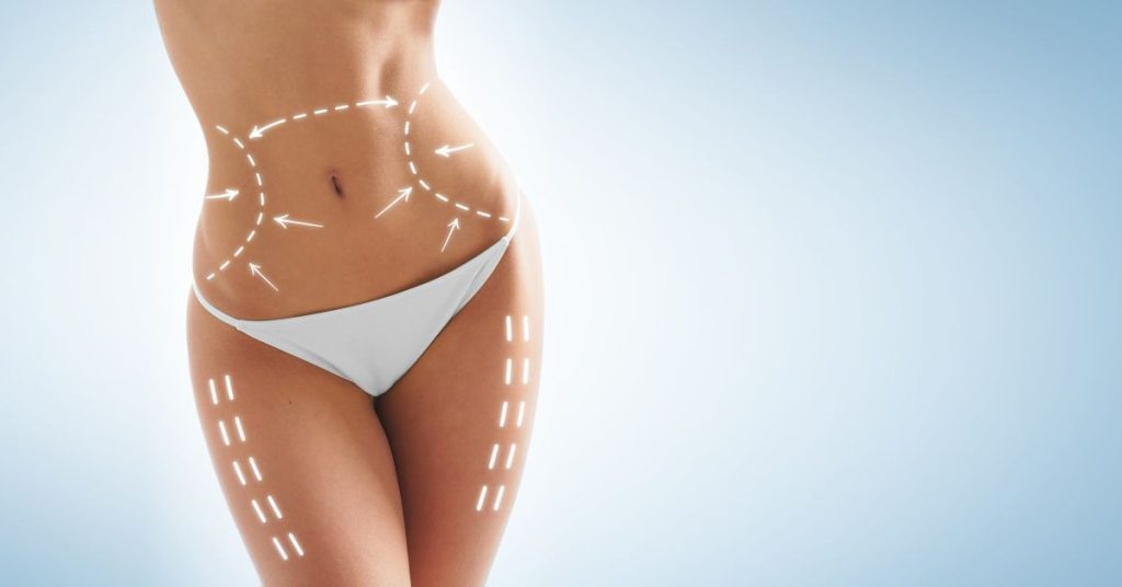 5 lucruri despre lipoaspiratie