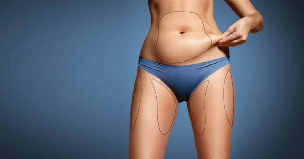 beneficiile operatiei de liposuctie