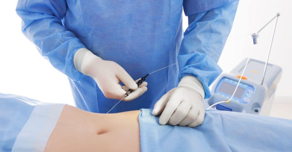 diferenta liposuctie laser clasica