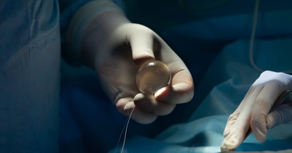 vedere din apropiere cu mana unui medic ce tine un implant testicular din silicon