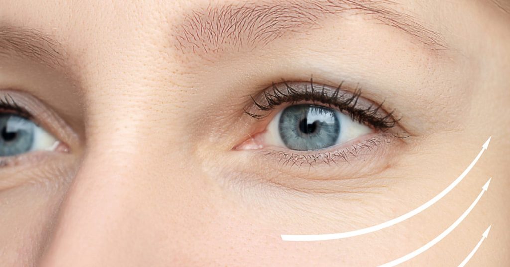 operatia de blefaroplastie