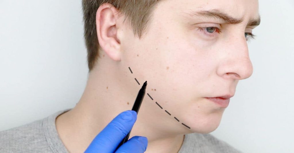 operatia de mentoplastie