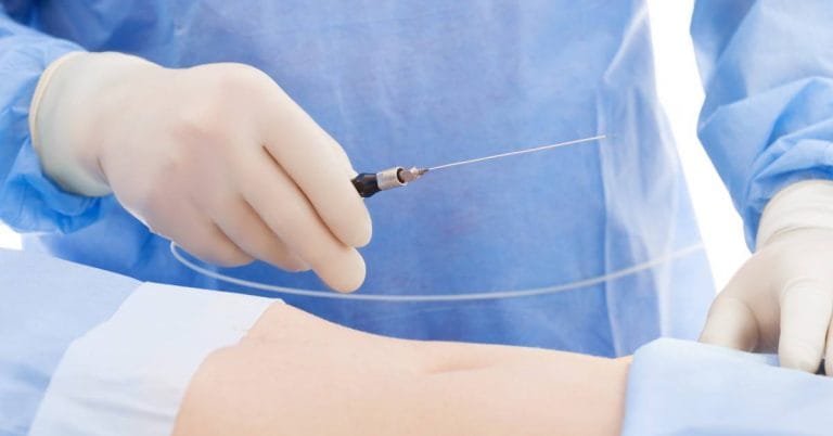 liposuctia laser