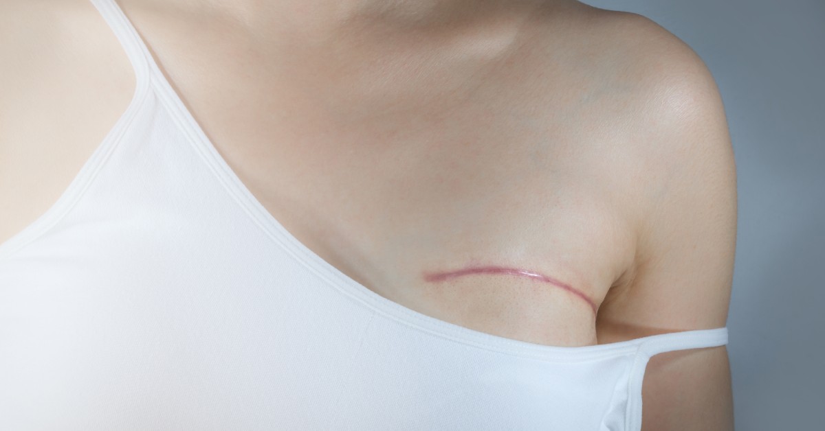 Reconstrucția mamară post mastectomie