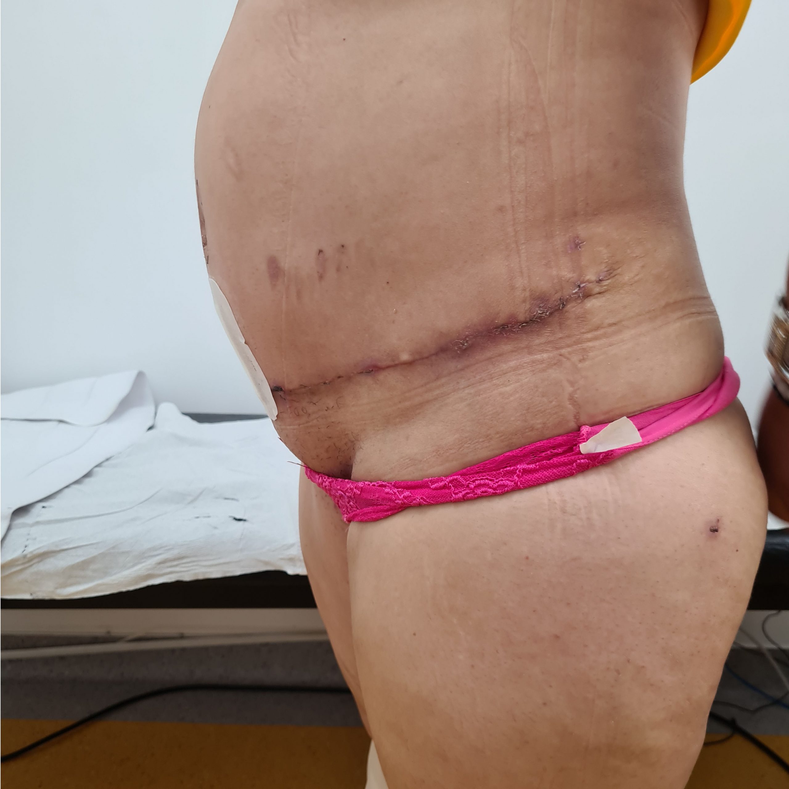 Abdominoplastie Before and After, Dr. Cristian Nitescu