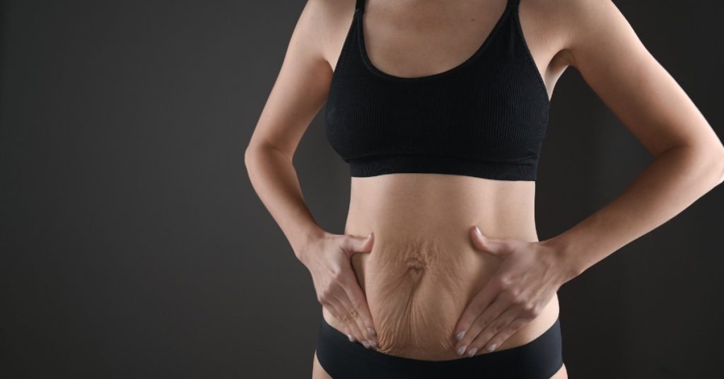 Abdominoplastie după o sarcină