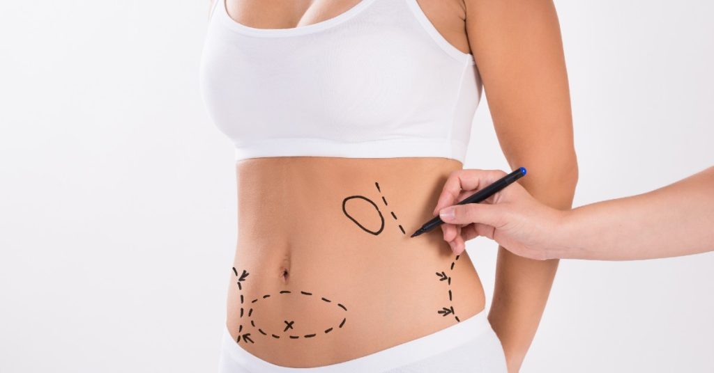 Operație de liposucție abdominală