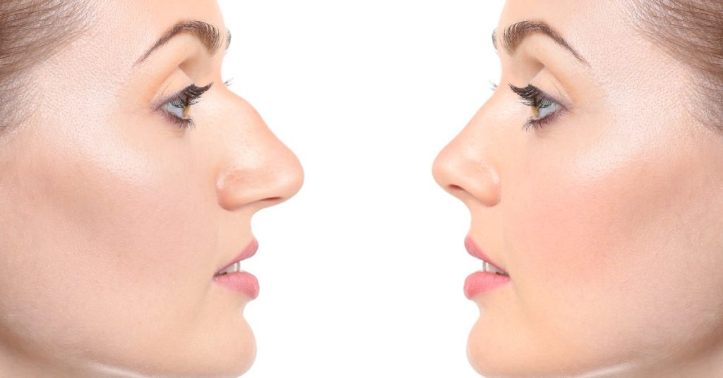 Operație de rinoplastie închisă/deschisă