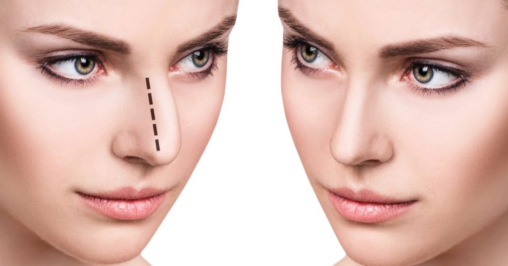 Rinoplastie, pro și contra, Dr. Nițescu