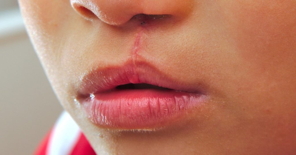 copil cu buza de iepure