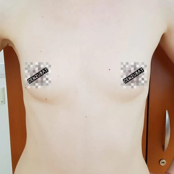 Implant mamar Înainte - Dr. Cristian Nițescu