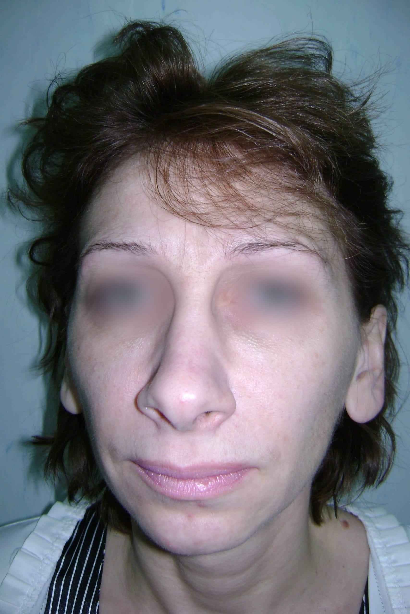 Lifting facial – Caz 1 - Înainte