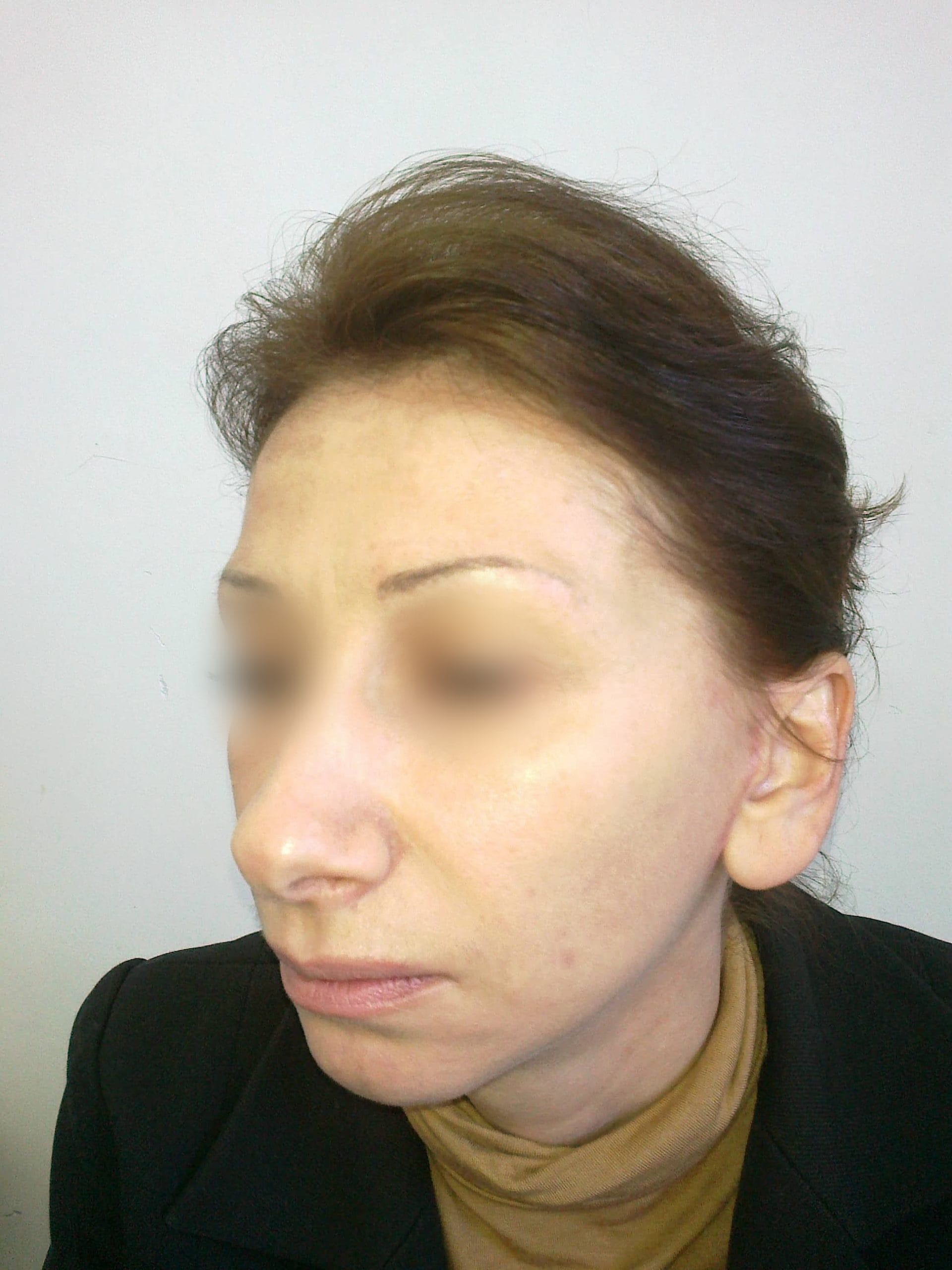 Lifting facial – Caz 1 - După