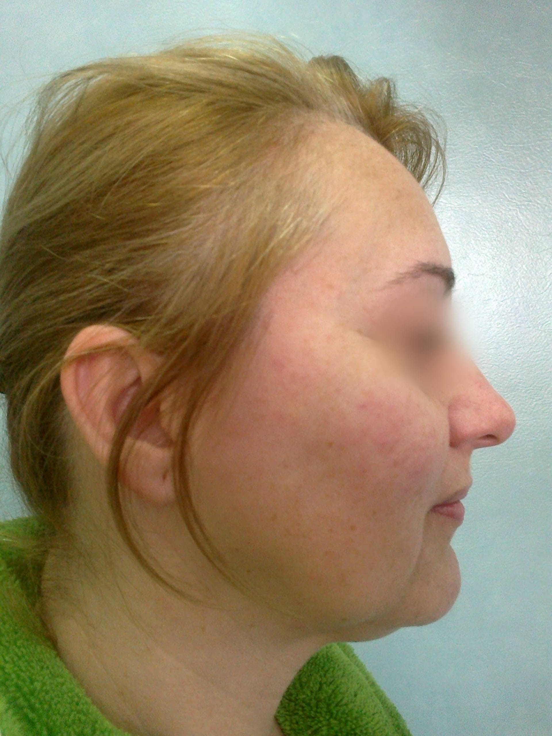Lifting facial – Caz 2 - Înainte