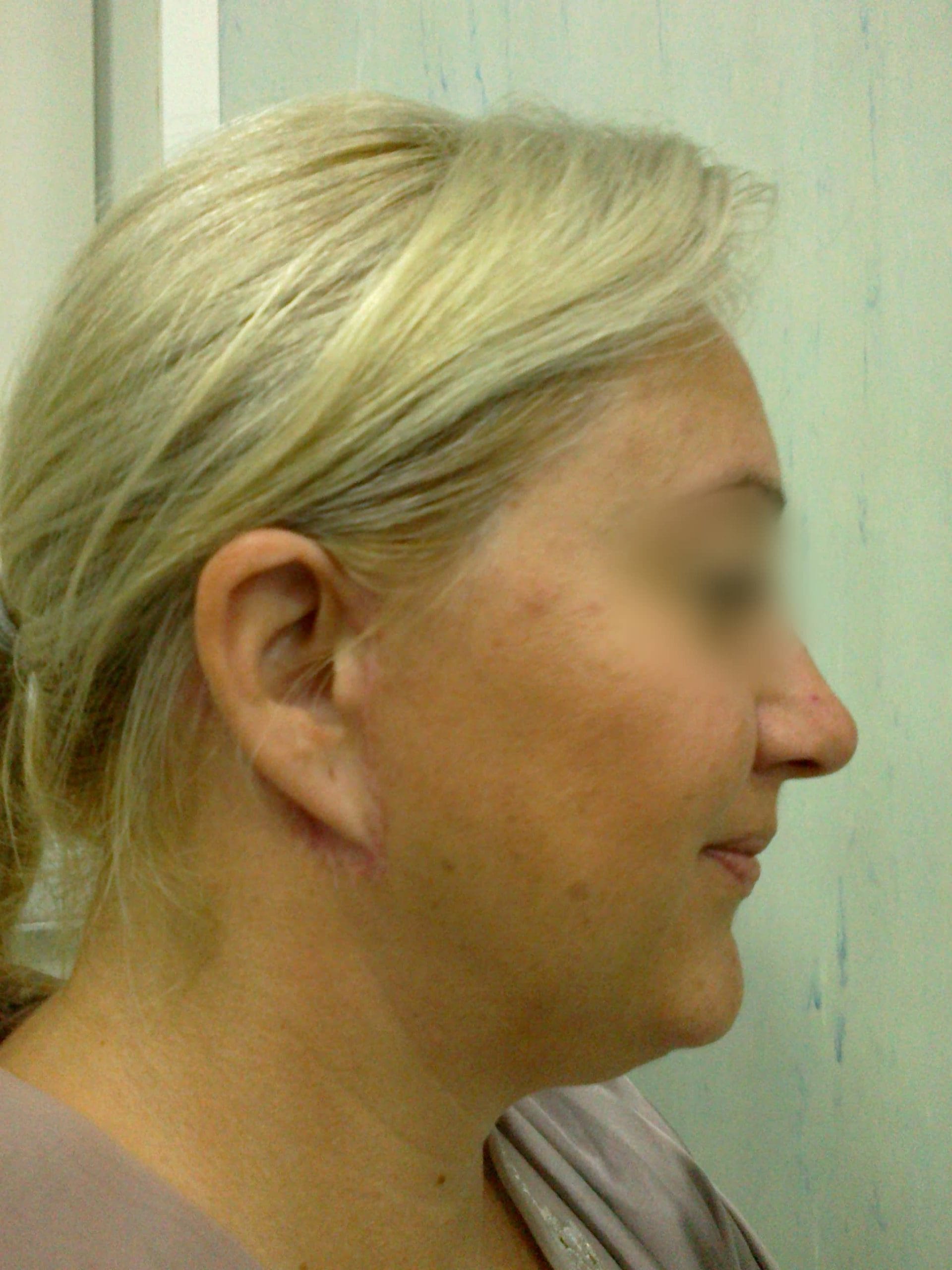 Lifting facial – Caz 2 - După
