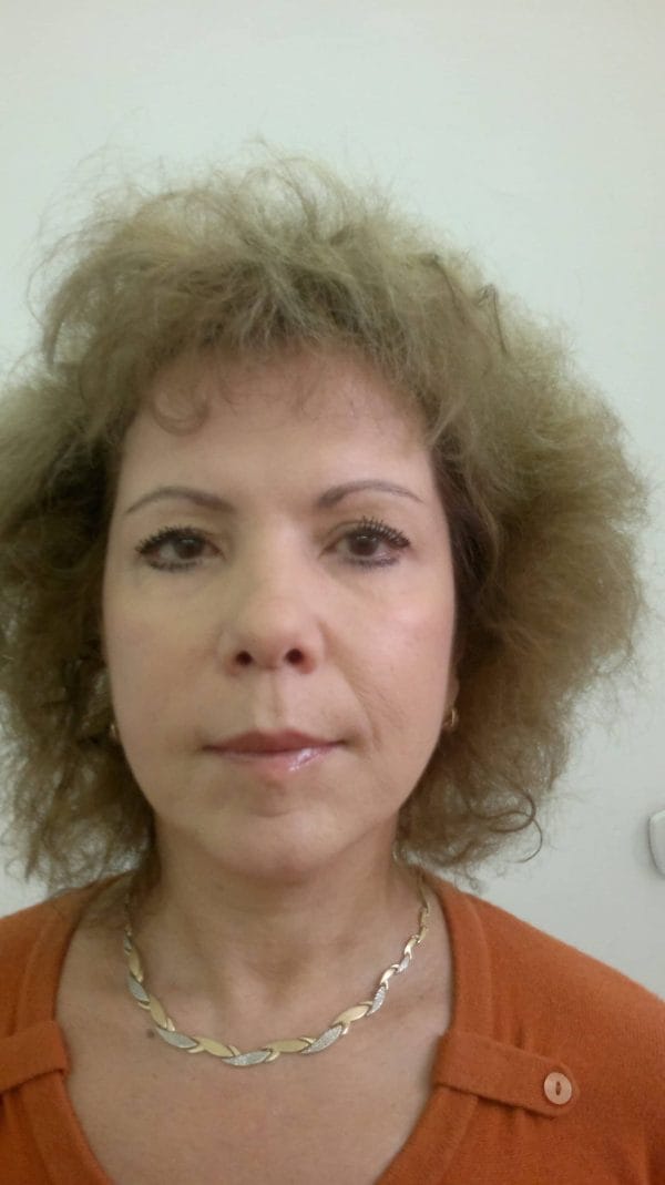 Lifting facial – Caz 3 - După