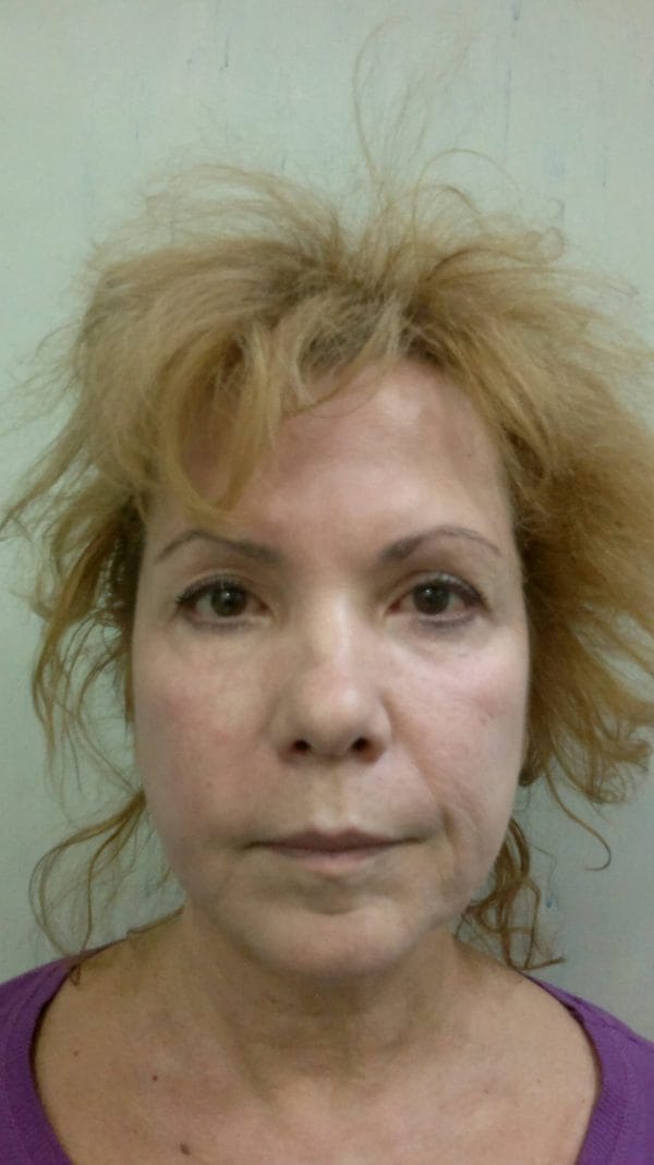 Lifting facial – Caz 3 - Înainte