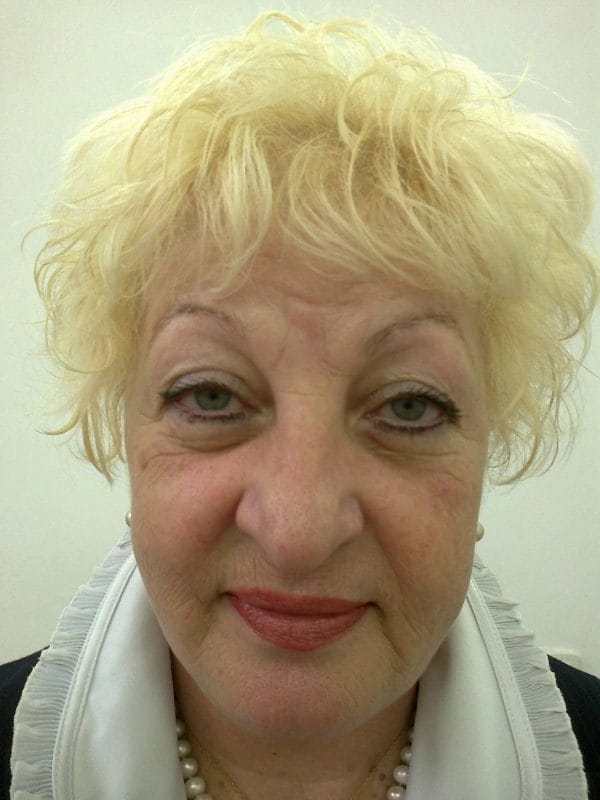 Lifting facial – Caz 4 - După