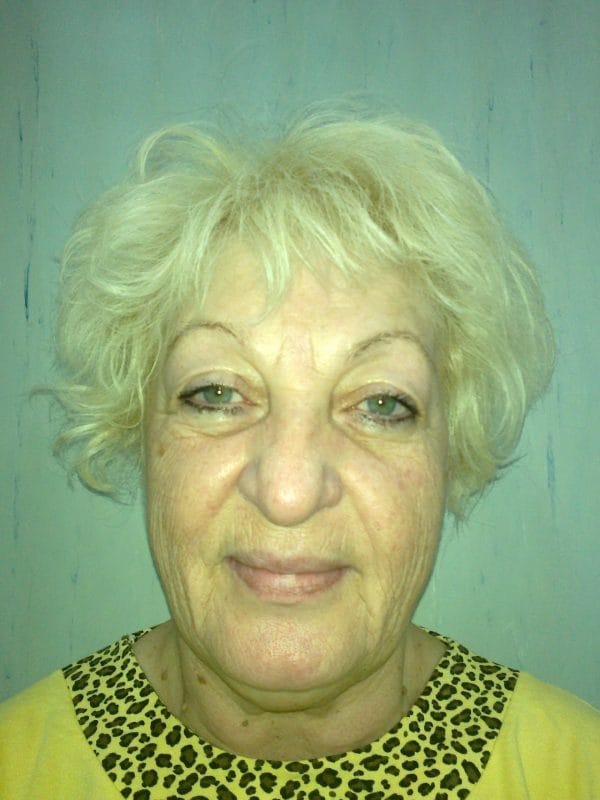 Lifting facial – Caz 4 - Înainte