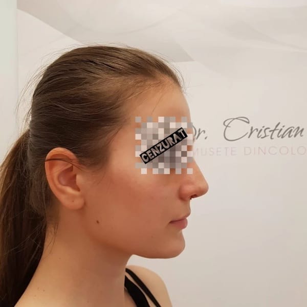 Rinoplastie După - Dr. Cristian Nițescu