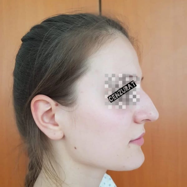 Rinoplastie Înainte - Dr. Cristian Nițescu